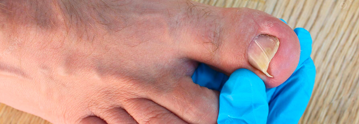 Understanding Ingrown Toenails: Are You Susceptible and How Effective is Surgery as a Solution?